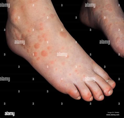 Top 104+ Pictures Contact Dermatitis On Feet Pictures Completed