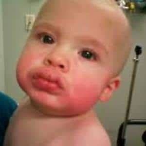 Baby Egg Allergy Rash Pictures - Get More Anythink's