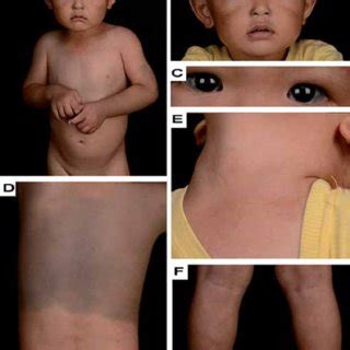 (A and B) Bilateral nevus of Ota on the face. (C) Blue spots on the... | Download Scientific Diagram