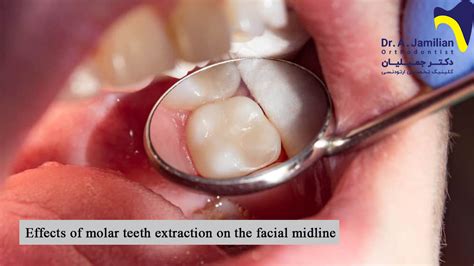 Effects of molar teeth extraction on the facial midline - Dr Jamilian