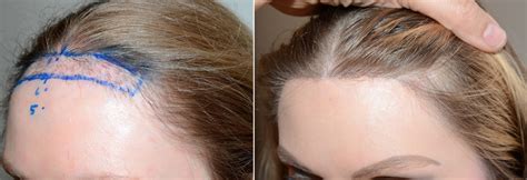 Forehead Reduction Surgery Before and After Photos - Foundation For ...