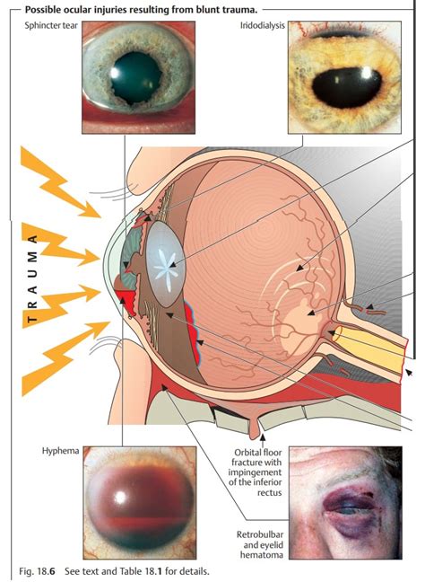 Blunt Ocular Trauma (Ocular Contusion)