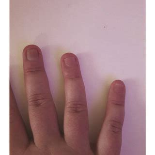 Dystrophic nails of the hand with nail psoriasis (leukonychia, nail... | Download Scientific Diagram