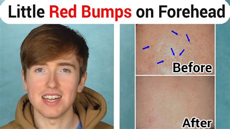 Get Rid Of Bumps On Your Forehead - get rid of bumps