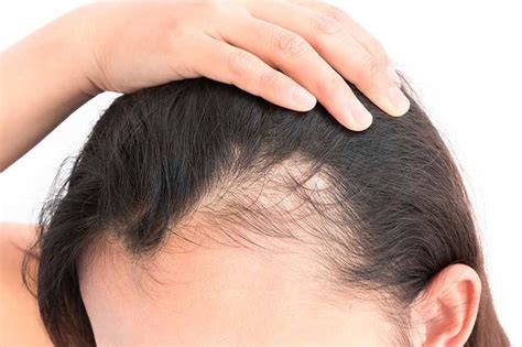 What is female androgenetic alopecia - Insalaco Clinic