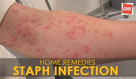 Fastest way to cure staph infection