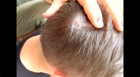 The Grossest BotFly Removal From This Boy’s Head Is Tough To Watch [VIDEO]