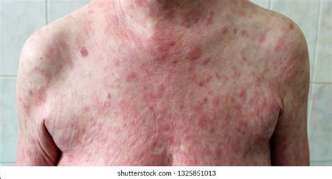 Skin Lymphoma Royalty-Free Images, Stock Photos & Pictures | Shutterstock