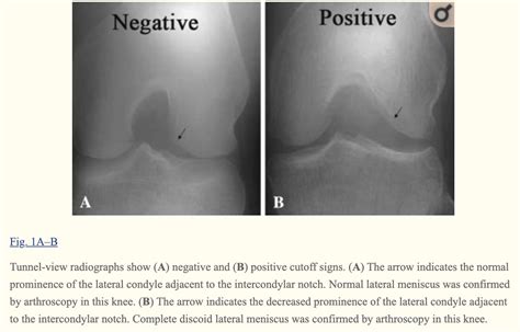 Discoid Lateral Meniscus - Orthosports