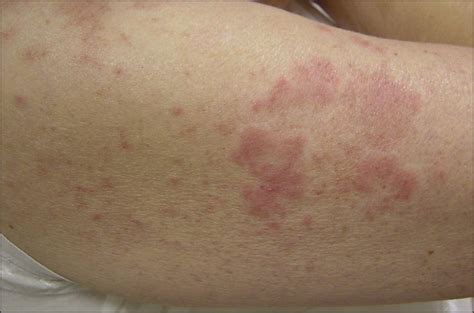 Autoimmune Rashes On Legs