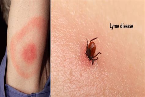 What is Lyme Disease? – Causes, Symptoms, Diagnoses, and More