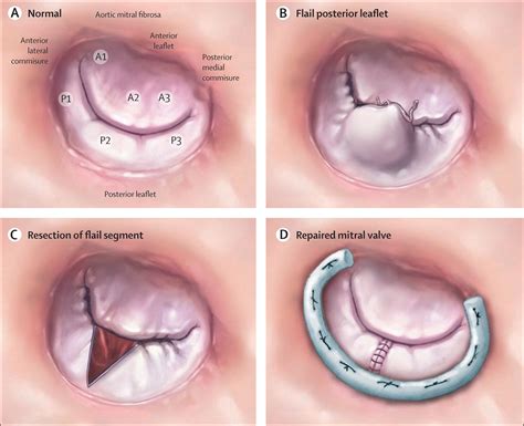 Mitral regurgitation - The Lancet