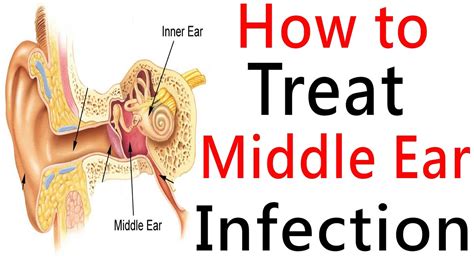 Middle Ear Infection & Middle Ear Effusion - Causes & Treatment