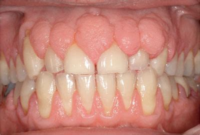 Gingival Hyperplasia : Causes, Symptoms, and Treatment