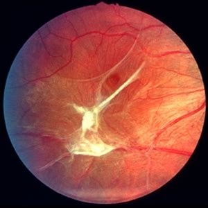 Epiretinal Membrane (ERM): How serious is it?! - Ophthalmology Education