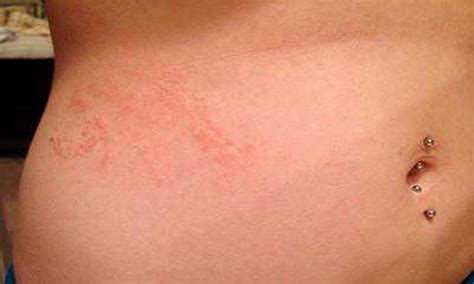 How To Identify Scabies Rash Its Management Dr Sudhee - vrogue.co