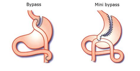 Mini bypass Tunisie : chirurgie obesite pour perdre rapidement du poids