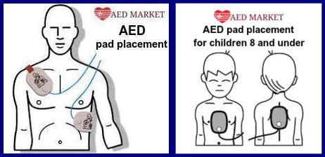 Proper AED Pad Placement | AED Market