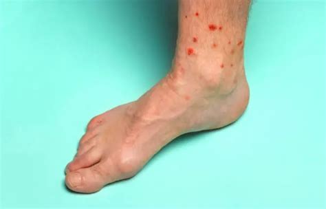 Top 5 Mosquito Bite Vs Bed Bug Bite | Pest Professional Services