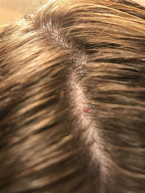 Anyone know what his red thing is on my scalp I have a ton of them on my scalp : r/WomensHealth