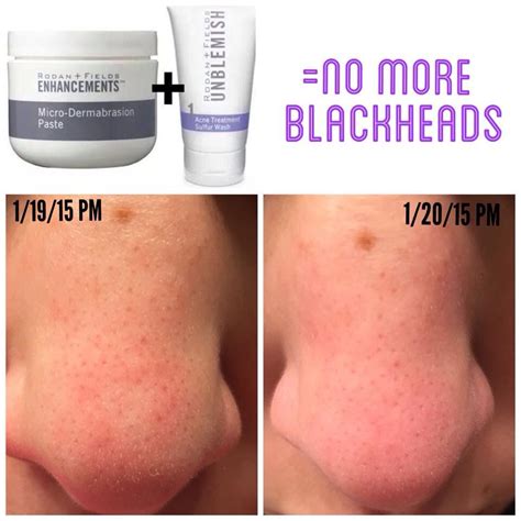 Blackheads be gone! Microdermabrasion Benefits, Microdermabrasion ...