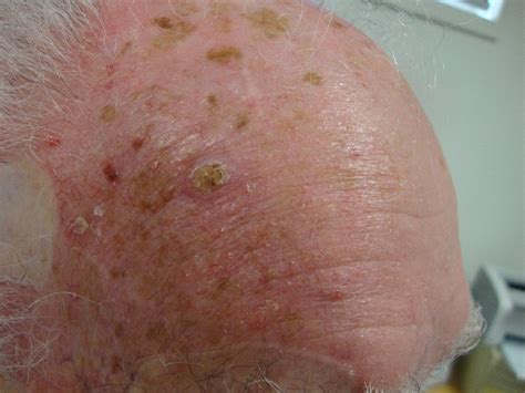 ACD A-Z of Skin - Squamous Cell Carcinoma