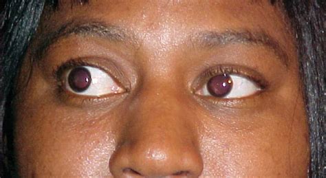 Mild Thyroid Eye Disease May Respond to Doxycycline