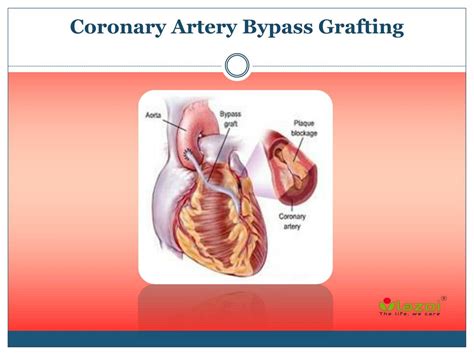 PPT - Coronary Artery Bypass Grafting PowerPoint Presentation, free download - ID:7935908