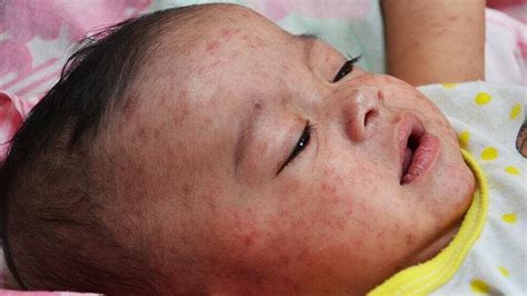 MEASLES Symptoms, prevention and treatment