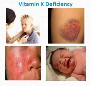 Good Health & Nutrition by Odra: Vitamin K : Deficiency, Supplements ...