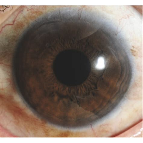 Patient 1 with iris posterior synechiae and corneal suture. (a)... | Download Scientific Diagram