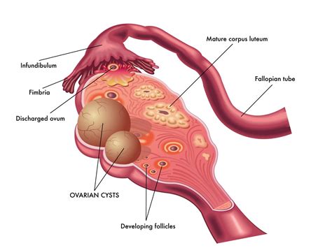 Pcos