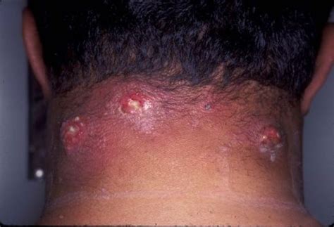 Abscess Boil | Skin diseases, Skin, Skin boil