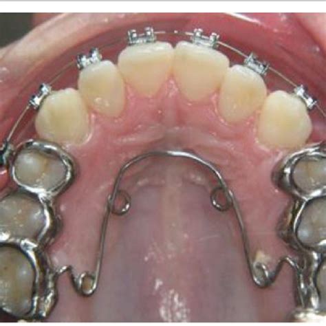 Patient example: Herbst appliance in combination with a quadhelix ...