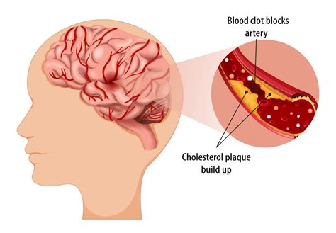 Treatment Advances for Common Cause of Ischemic Stroke - Cedars-Sinai Pulse