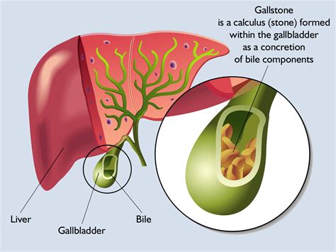 How do gallstones develop? - Mysurgeryabroad - Medicover Hospital - Hospital abroad, affordable ...