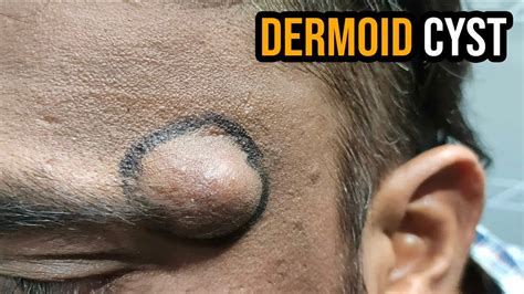 Dermoid Cyst Removal On Face - Video Spotter