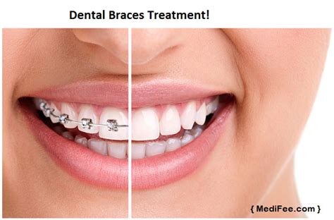 Dental Braces Treatment in India