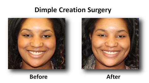 Dimple Creation Surgery Before And After