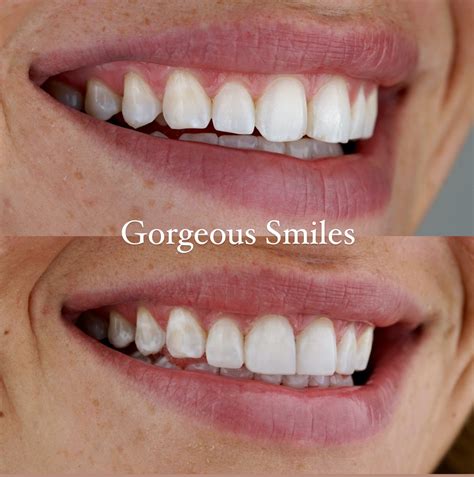 Dental Bonding Before And After Pictures - Gorgeous Smiles