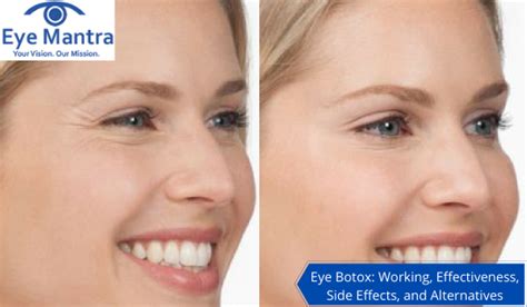 Eye Botox | Effectiveness, Side Effects, and Alternatives