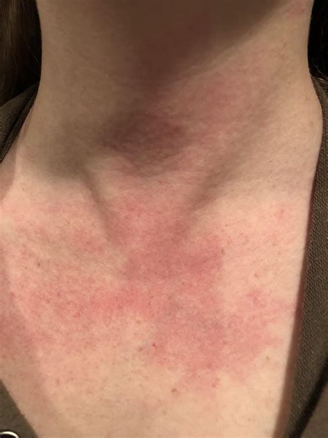 Lupus Skin Rash On Neck