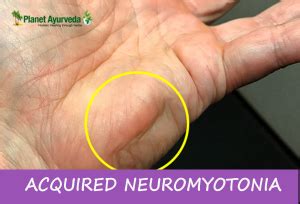 Symptoms of Acquired Neuromyotonia? Archives - Planet Ayurveda