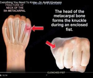 Boxer’s Fracture — OrthopaedicPrinciples.com