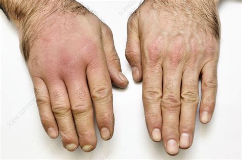 Cellulitis Hand Child