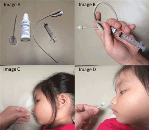 20 ways of removing a nasal foreign body in the emergency department