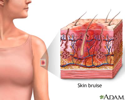 Bruise Information | Mount Sinai - New York