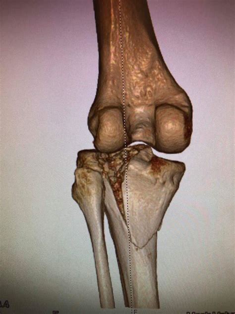 Tibial Plateau Fractures - what are they and how they can be treated