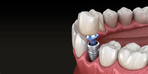 Single Dental Implants | Grace Dental | Framingham, MA