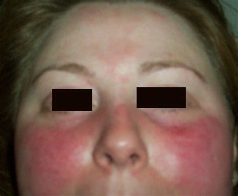 Rash on Face - Treatment, Causes, Pictures - HubPages